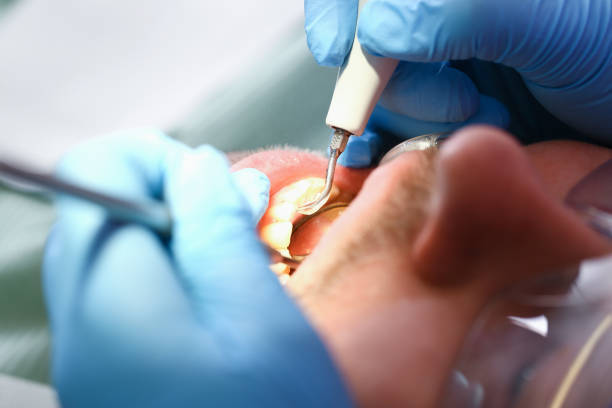 Best Emergency Gum Treatment in Cheviot, OH